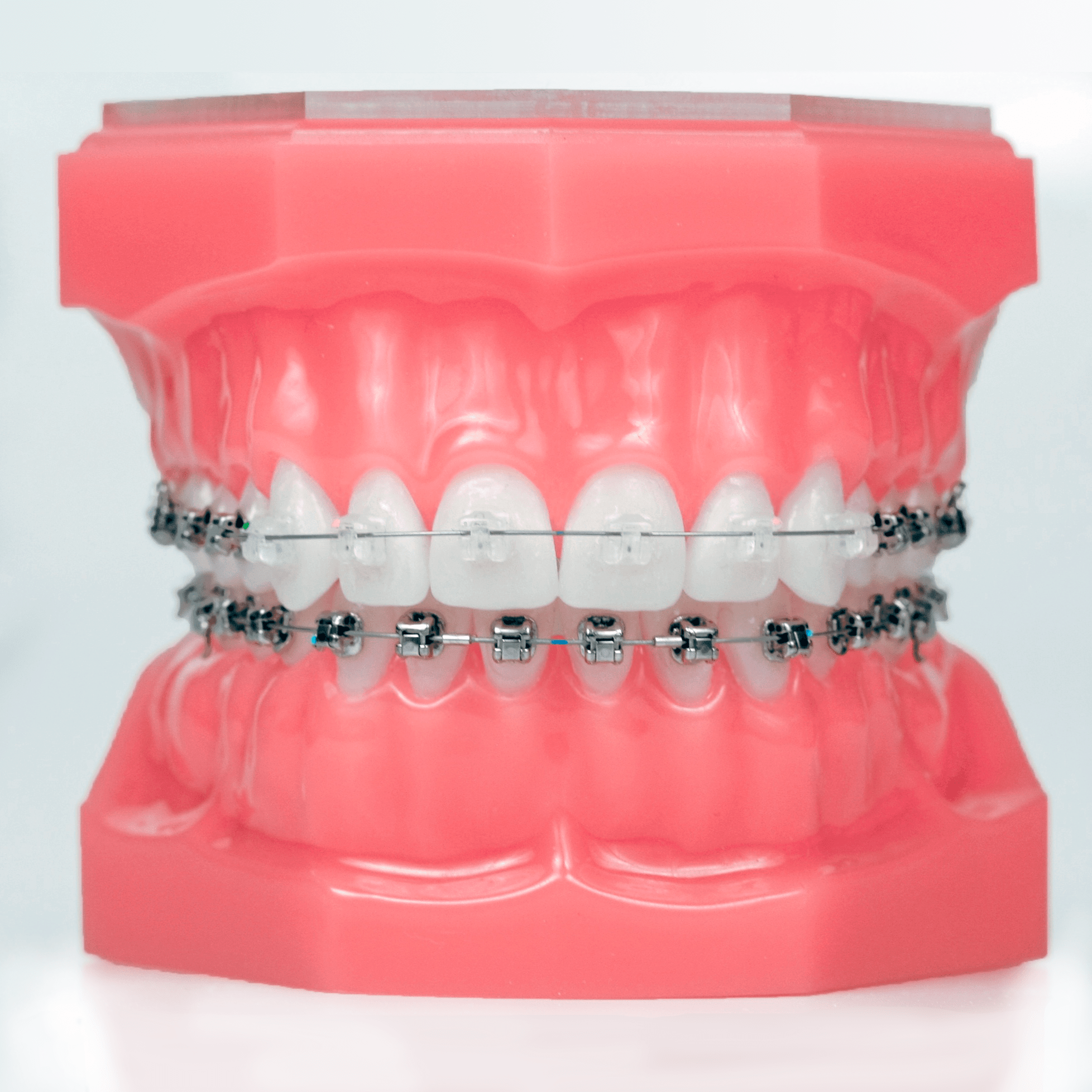 Установка безлигатурных брекетов в Дербенте. Брекеты Damon Clear