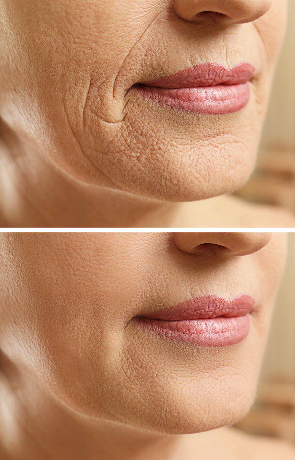 Морщины около рта: до и после