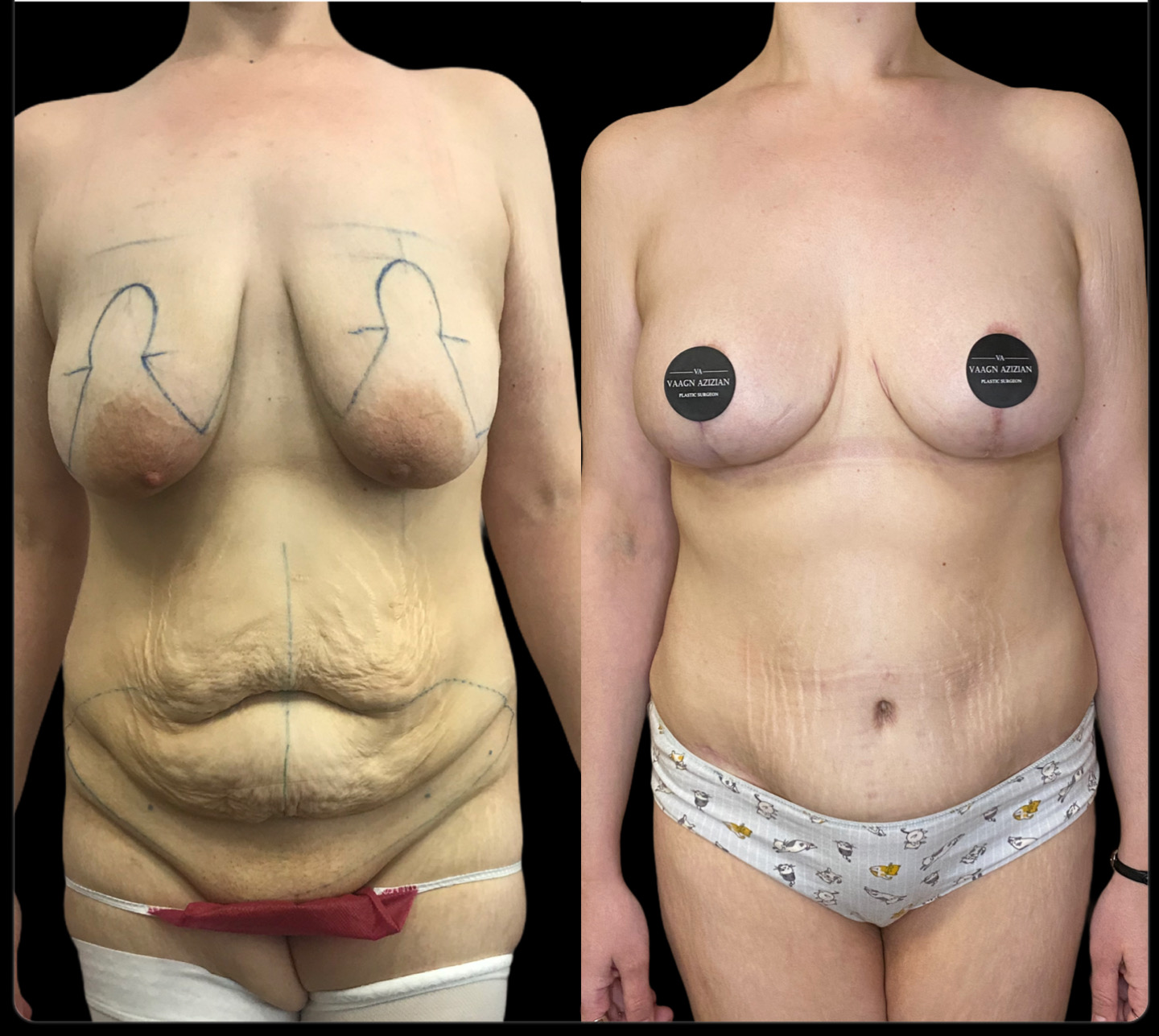 операция по подтяжке груди у женщин фото 49