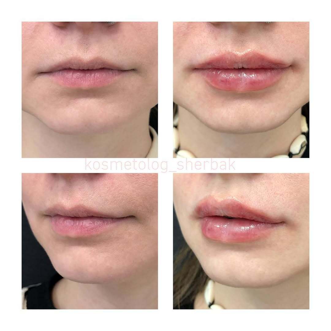 До и после контурной пластики губ. Увеличение объёма без утяжеления. PradusCOSMO, Васильевский остров