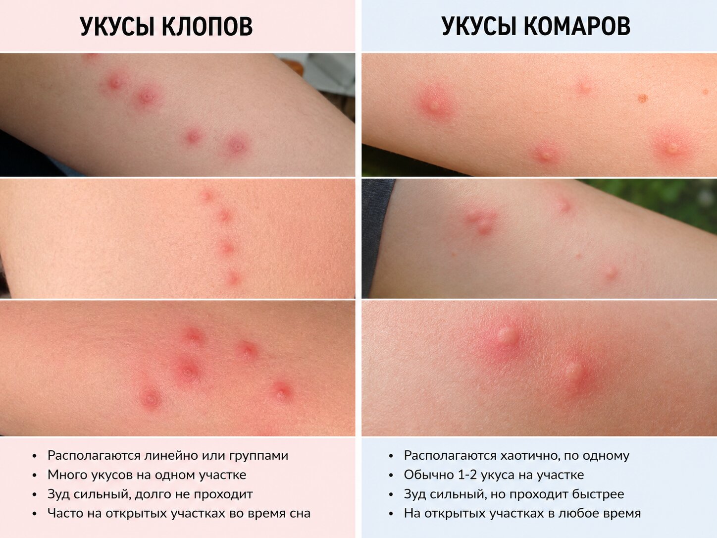Разница укусов клопов и комаров