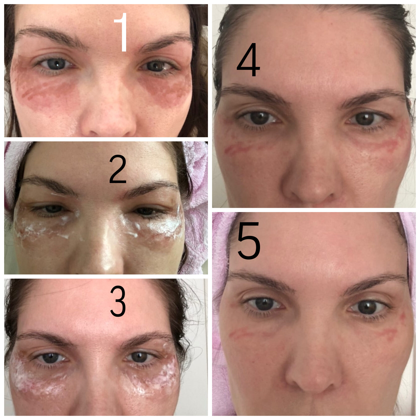 Результат удаления пигментных пятен после курса фототерапии ClearLight IPL — врач-косметолог Пузикова Анна Анатольевна, Санкт-Петербург