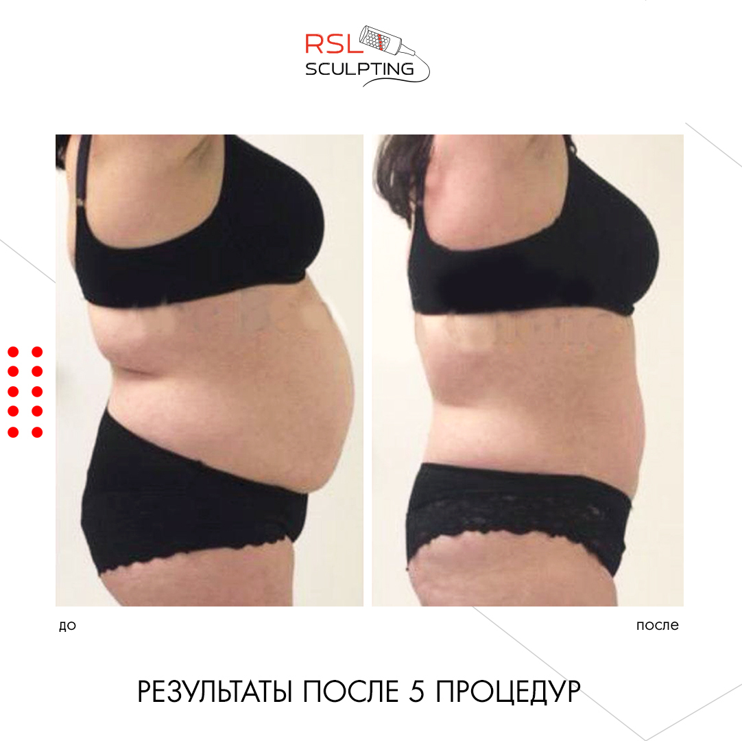 Живот до и после 5 процедур РСЛ-скульптурирования на аппарате Beautylizer RSL