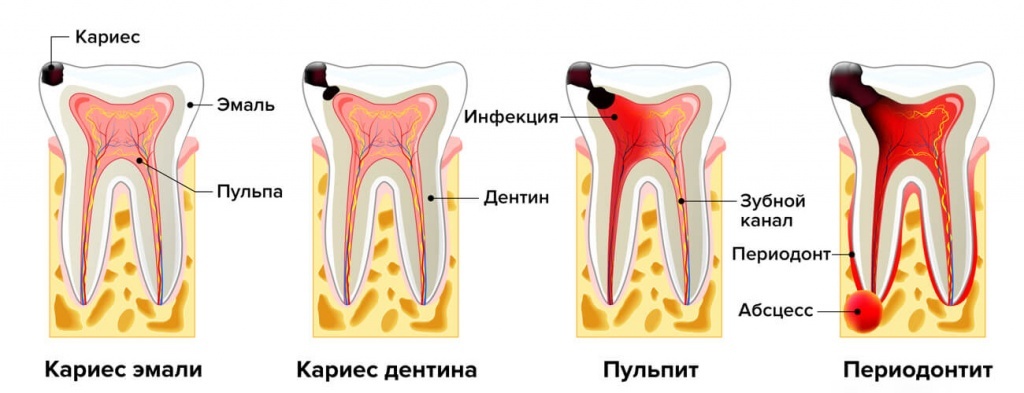 Лечение пульпита зуба по цене от ₽ - диагностика, симптомы, методы лечения