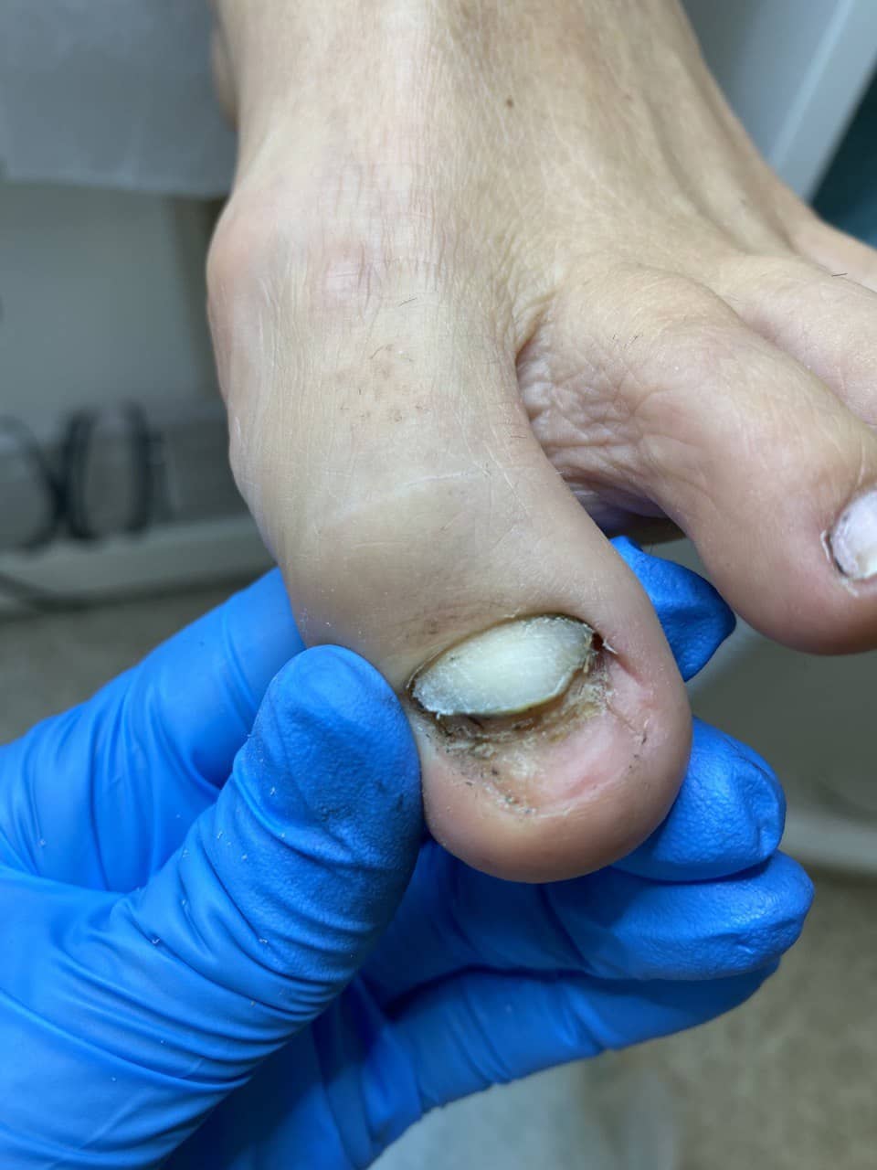 Протезирование