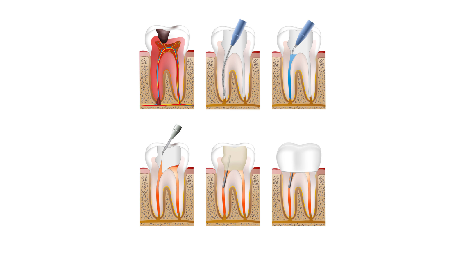 Временное лечение каналов зуба. Пульпит 2 канального зуба. Пульпит пломбировка каналов.