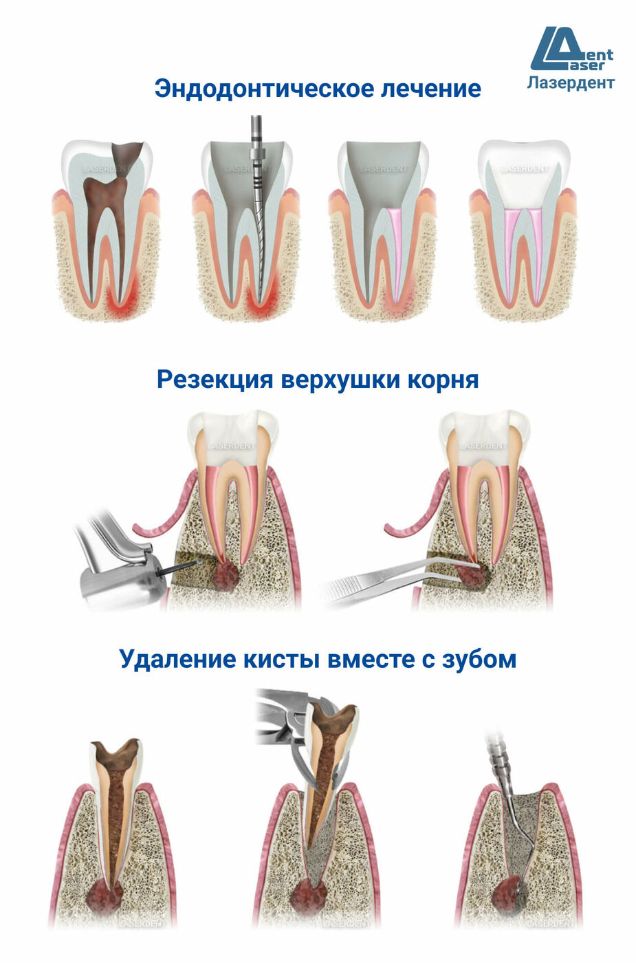 Удаление или лечение кисты зуба в Москве