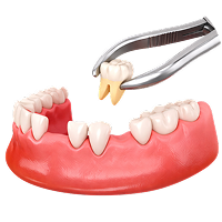 Удаление разрушенных зубов