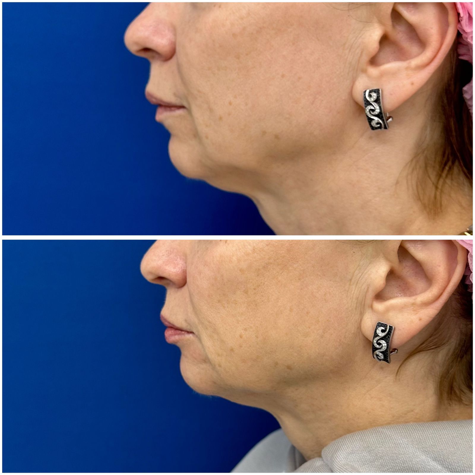 Фото до и после: V-lifting в клинике PradusCOSMO, Санкт-Петербург. Безоперационное омоложение и восстановление овала лица