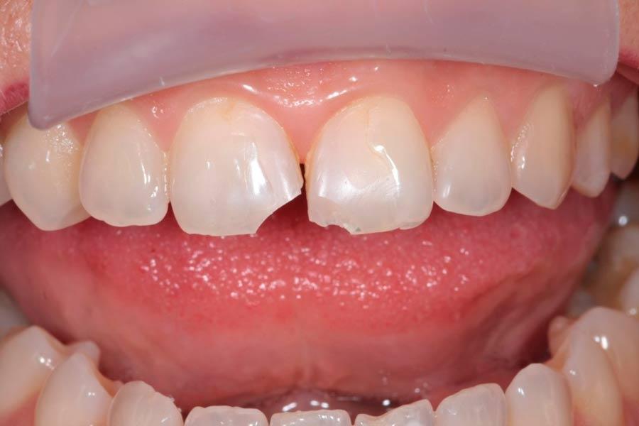 Что делать, если от зуба остался только корень? | Стоматология Мята
