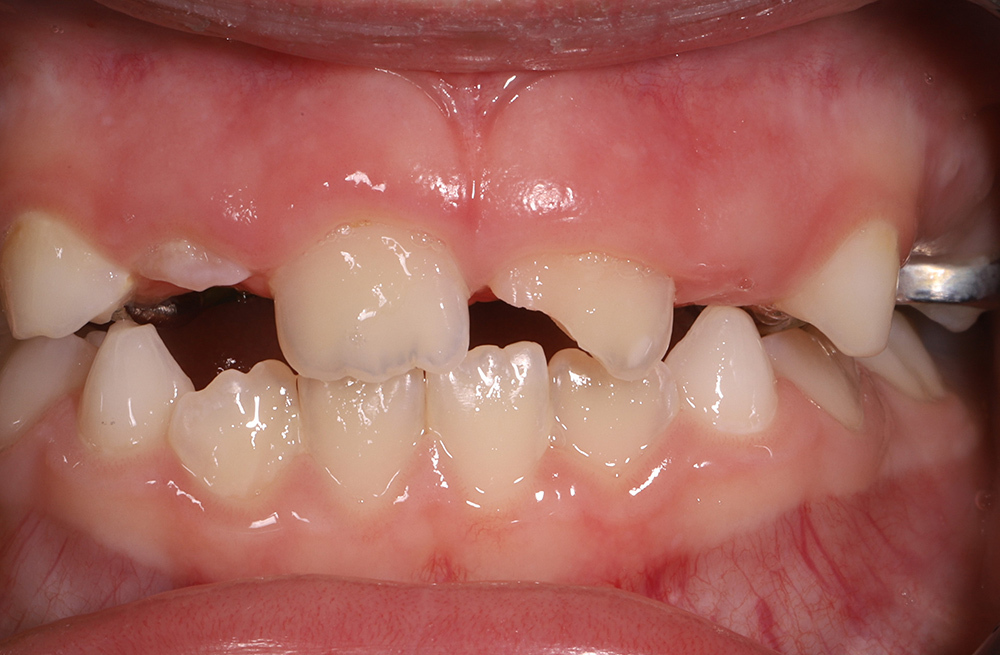Восстановление постоянного резца у ребёнка после травмы