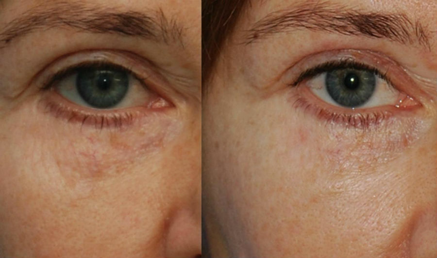 Устранение темных кругов под глазами с помощью PRP терапии до и после