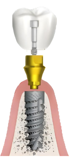 премиум импланты alpha-bio израиль, имплантация зубов в Санкт-Петербурге узнать точную стоимость протезирования