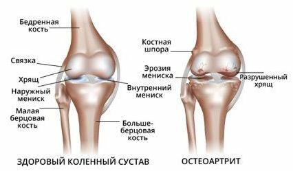Синовит коленного сустава: причины, симптомы, лечение
