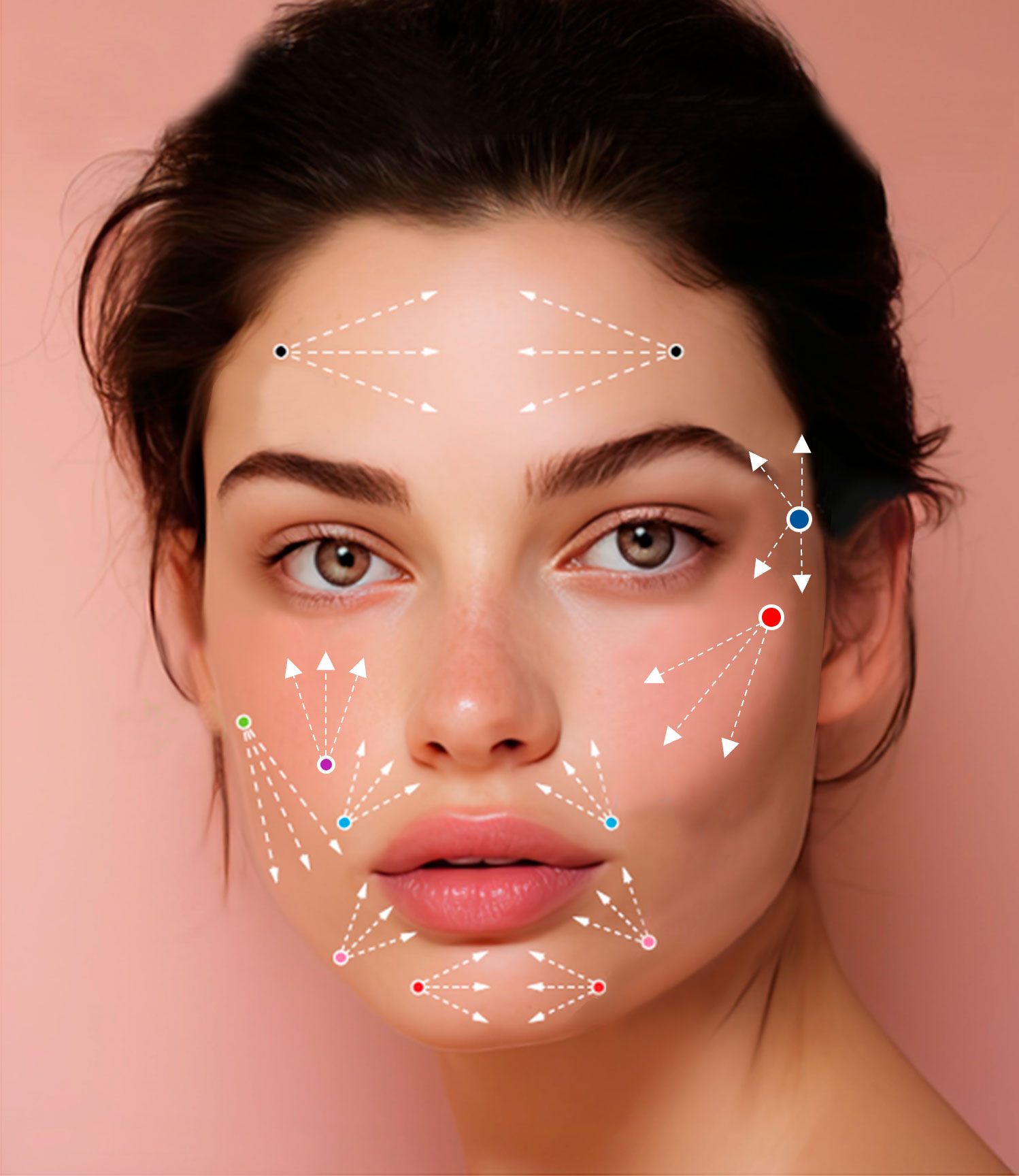 Ultracol - филлер на основе полидиоксанона