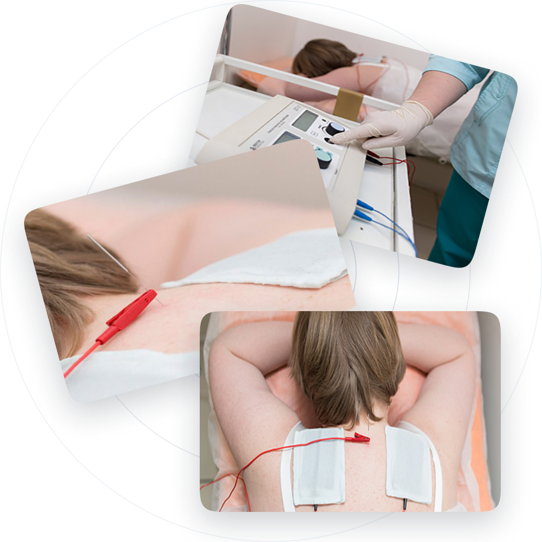 Внутритканевая электростимуляция ВТЕС в салехарде и янао