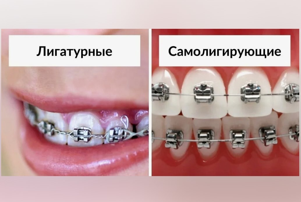 Виды Брекет Систем Фото