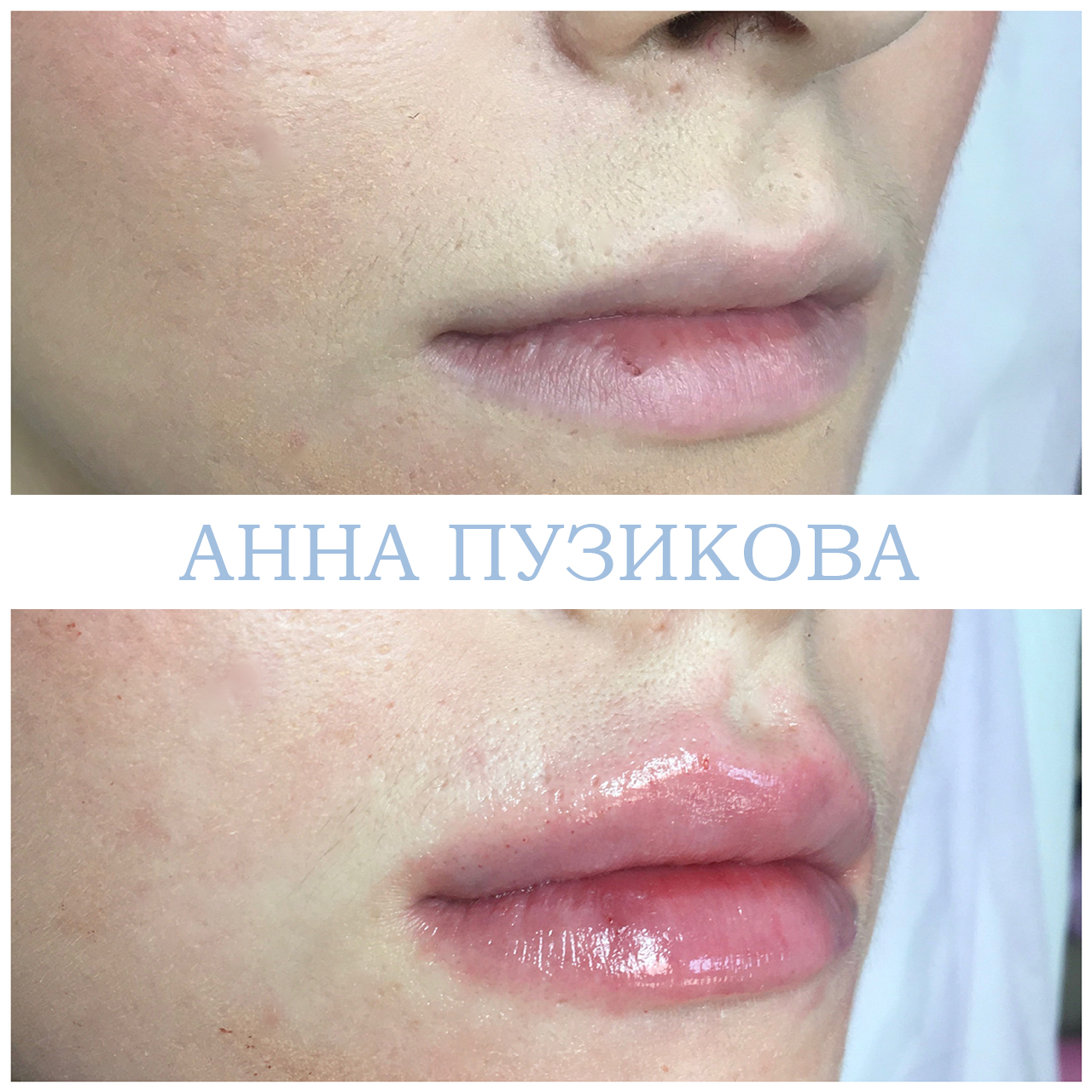 Фото до и после процедуры контурной пластики губ. Естественный результат после коррекции у косметолога Пузиковой Анны Анатольевны, клиника Прадус СПб.