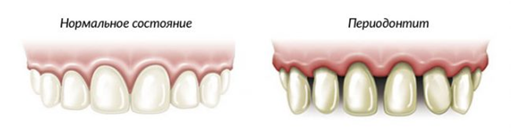 Нормальное состояние. Периодонтит Десна воспалилась.