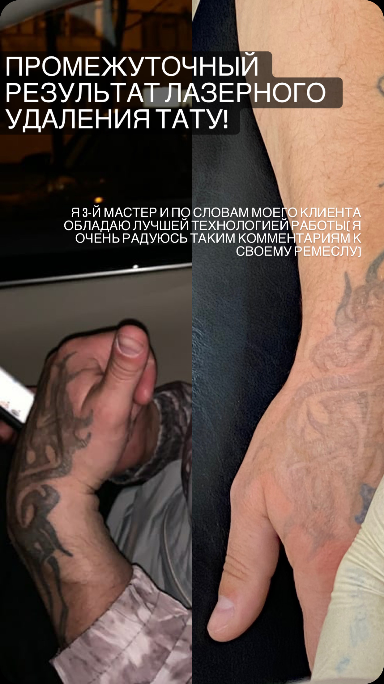 Как вывести неудачный татуаж - 6 самых популярных способов - блог manikyrsha.ru