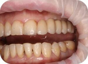 После имплантации