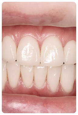 Протезирование зубов в Луганске