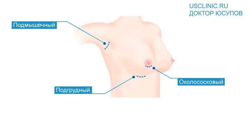 Эндопротезирование молочных желез