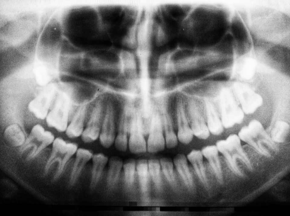 Рентген в стоматологии 