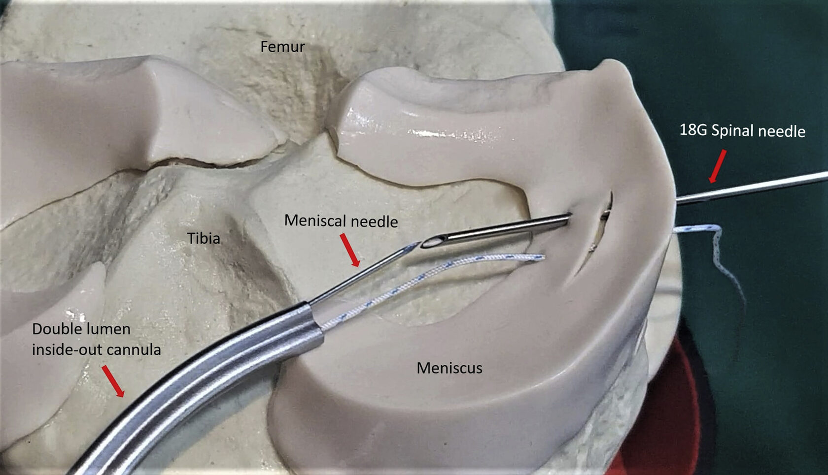 шов мениска