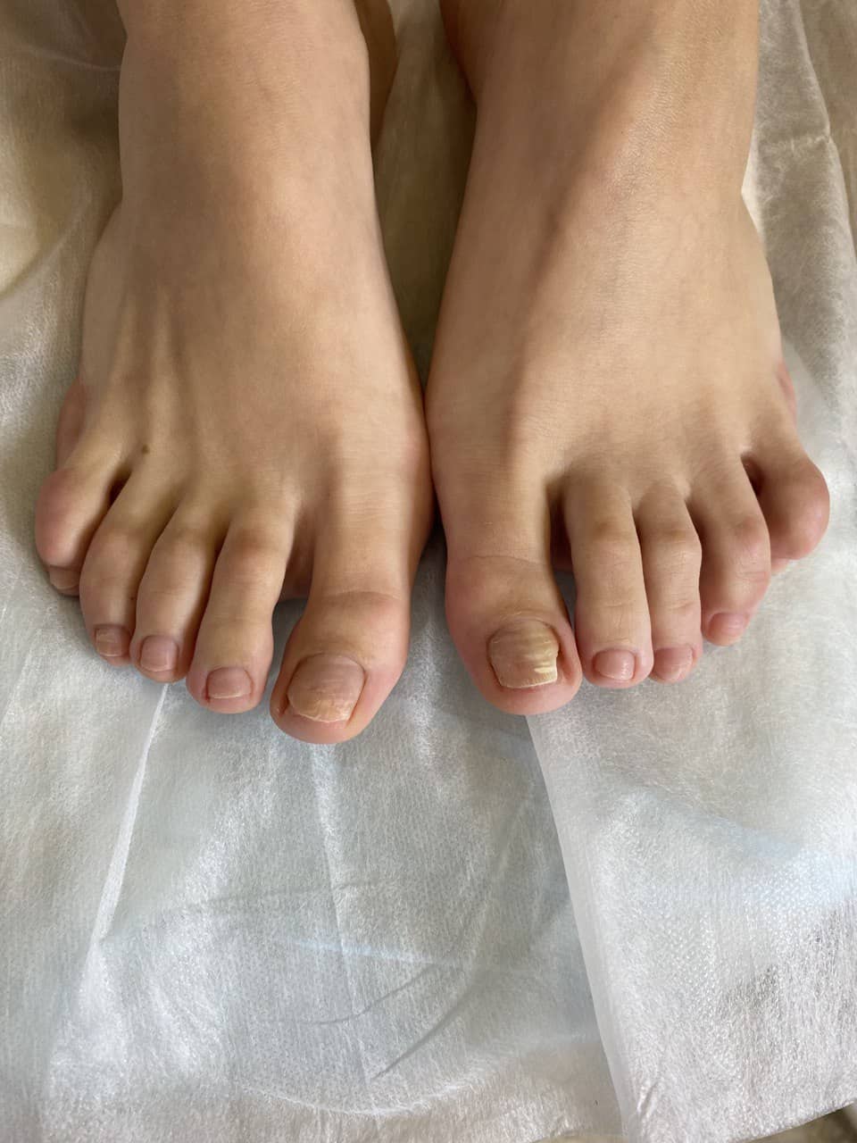 онихолизис ногтей