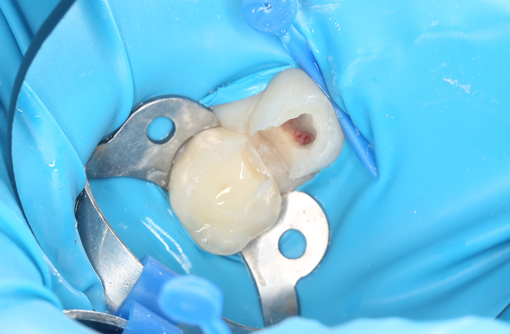 Лечение за один визит, где один зуб спасли коронкой, а соседний восстановили пломбой