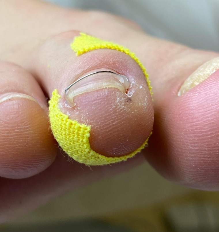 Установка титановой нити