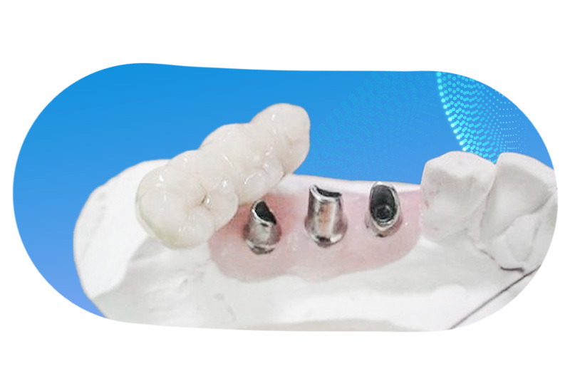 коронка на имплант спб