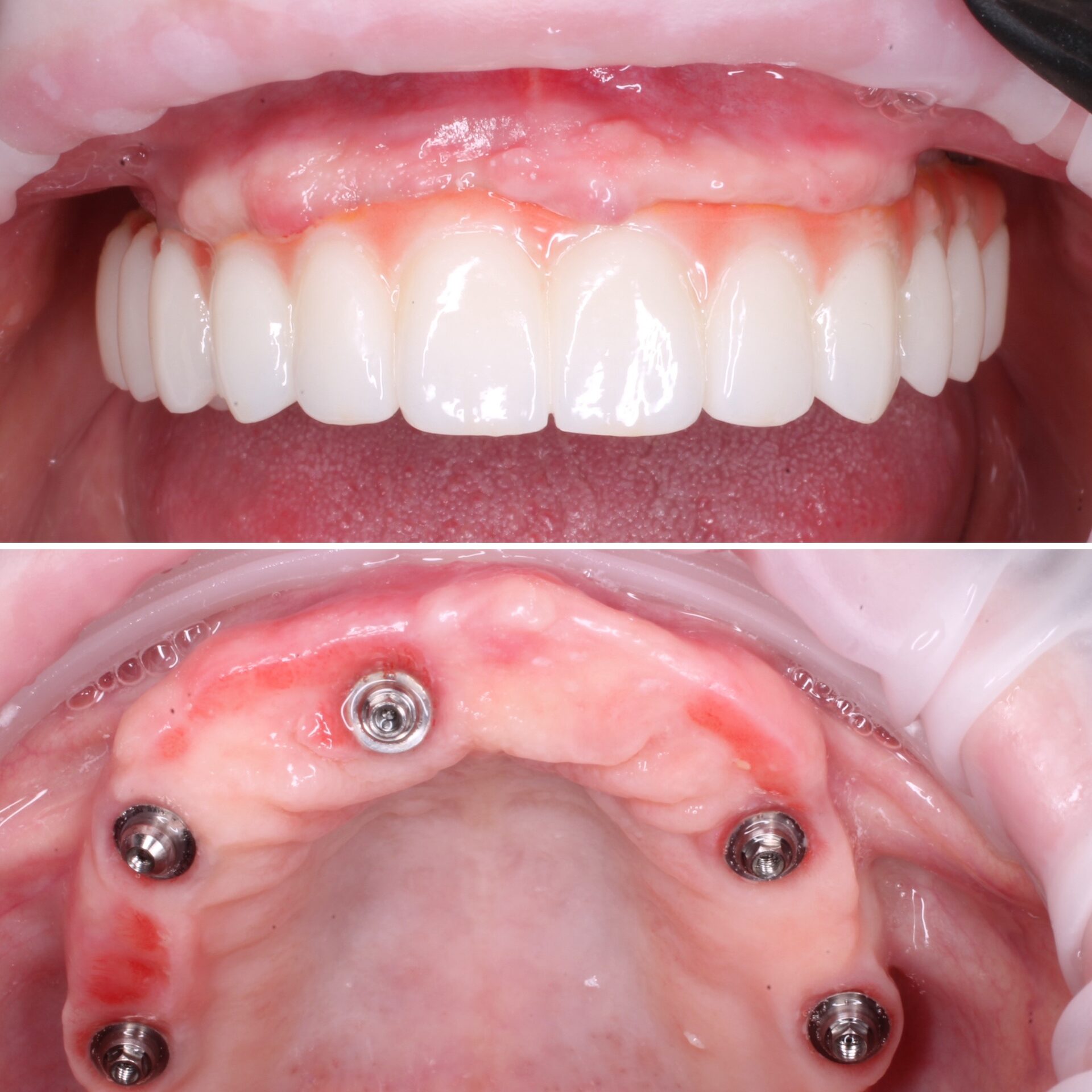 имплантация зубов чебоксары,имплантация зубов йошкар-ола,тотальная реабилитация на 6 имплантатах,протез несъемный в чебоксарах