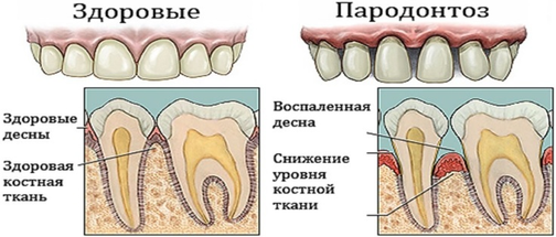 Пародонтоз фото людей