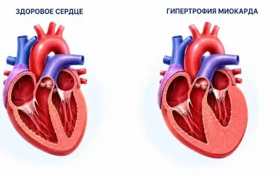 Здоровое сердце и гипертрофия миокарда
