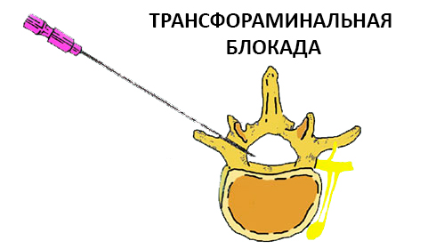 Блокада поясничного отдела позвоночника. Трансфораминальная блокада поясничного отдела это. Трансфораминальная эпидуральная блокада поясничного. Селективная трансфораминальная блокада. Трансфораминальная блокада спинального корешка.