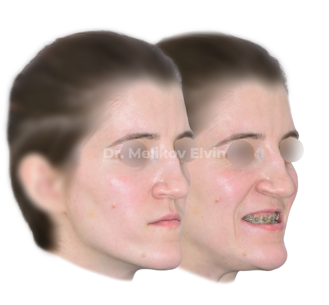 Мезиальный прикус