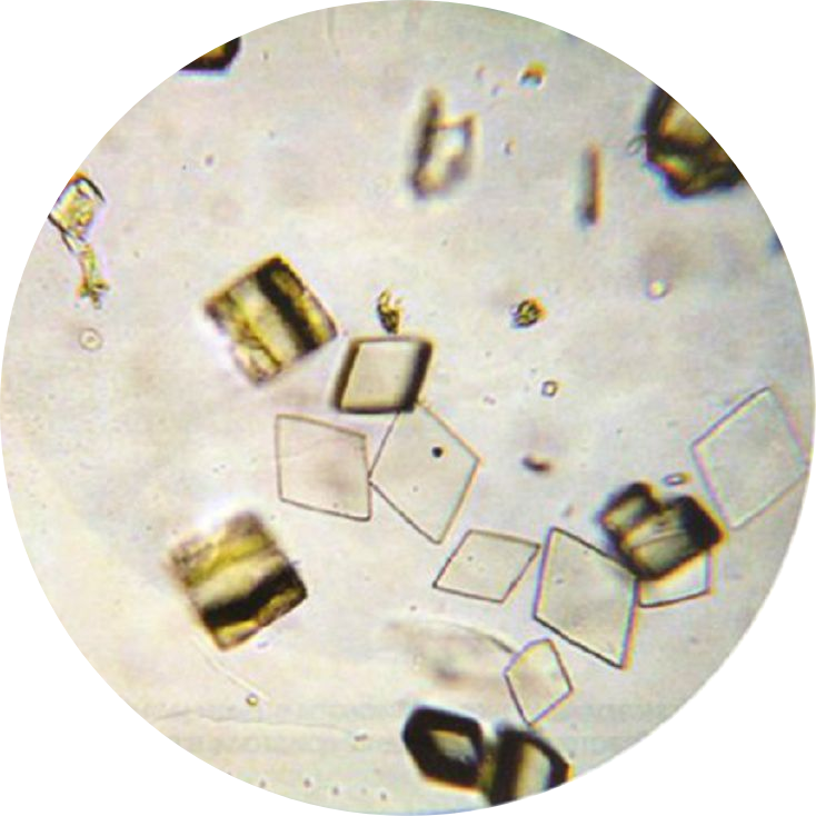 Высокая соль в моче. Микроскопия мочи Кристаллы мочевой кислоты. Соли мочевой кислоты микроскопия. Микроскопия осадка мочи трипельфосфаты. Трипельфосфаты мочевой кислоты в моче.