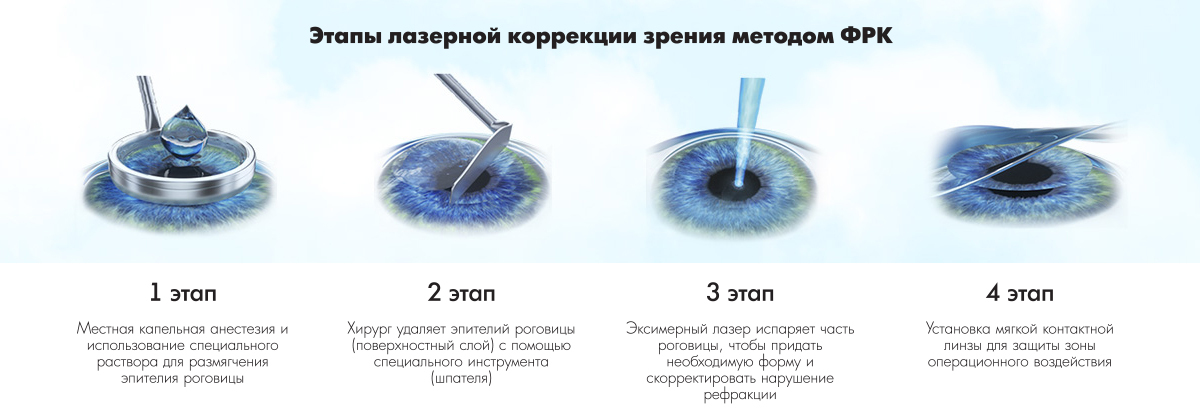 Лазерная коррекция зрения по методике FemtoLasik. ФРК.