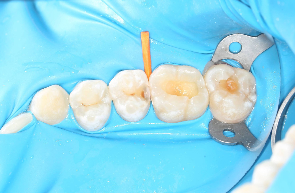 Минимально инвазивное восстановление трех зубов при скрытом кариесе и дефекте пломбы
