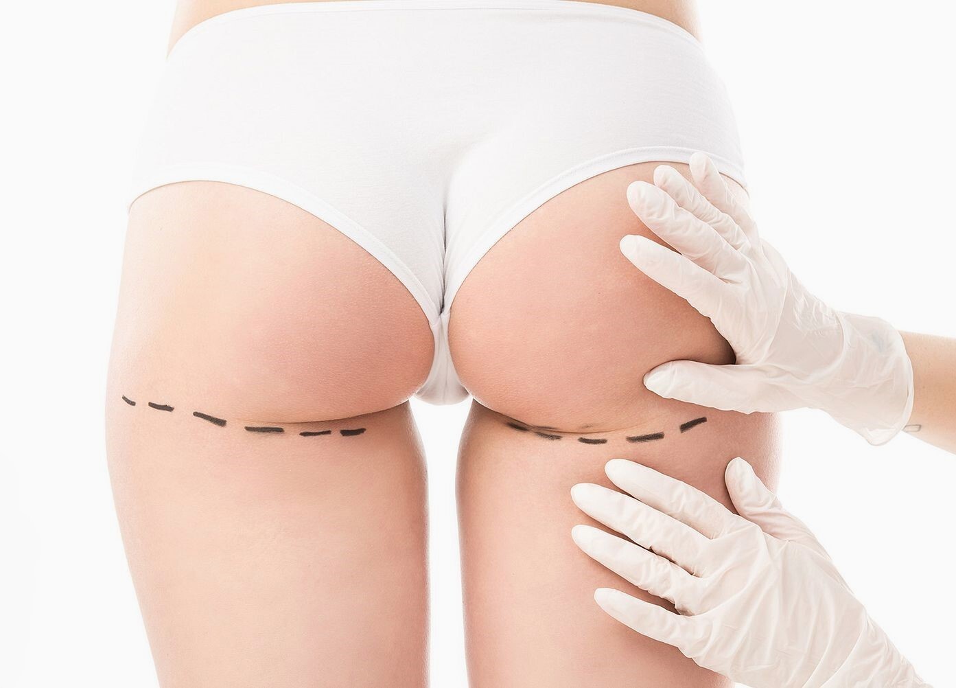 Схема проведения филаментлифтинга ягодиц