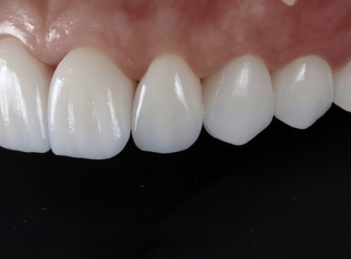 Восстановление разрушенного зуба с помощью имплантации и керамических коронок в клинике Пробел на Ленинградском проспекте.