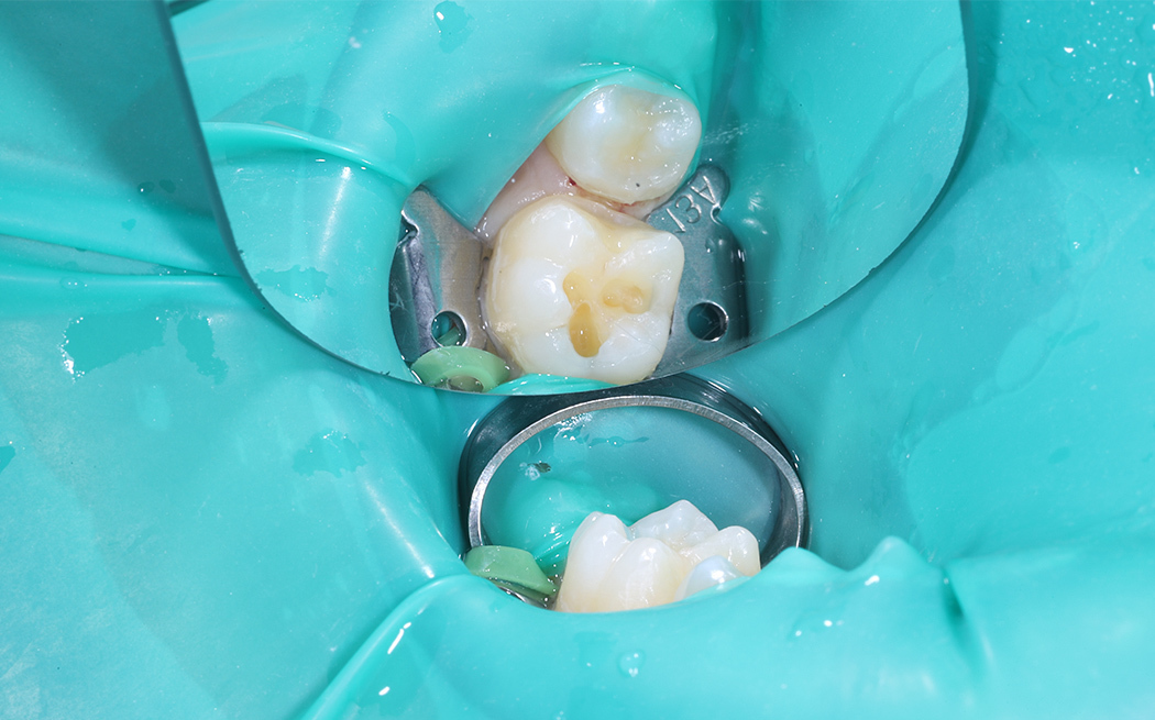 Восстановление жевательной поверхности материалом Harmonize A3