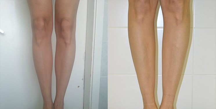 Круропластика ног. Коррекция формы голени в СПБ. Круропластика чем опасна.
