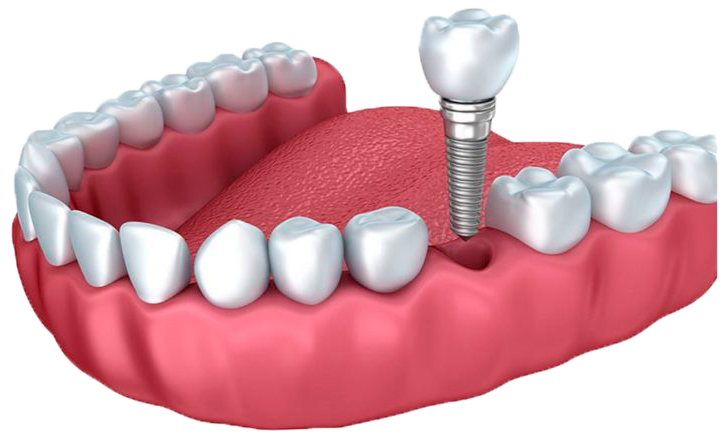 Установка имплантов в Дербенте. Имплантация при отсутствии одного зуба.