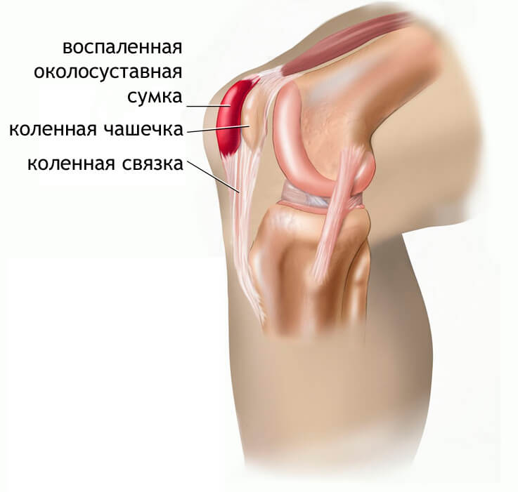 Боль в колене. Почему болит колено?| steklorez69.ru
