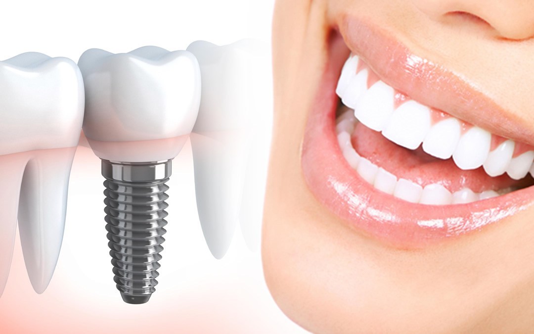 Протезирование зубов и зубных имплантов