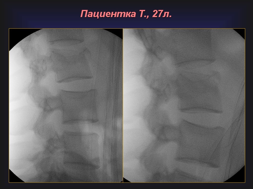 Фото компрессионного перелома