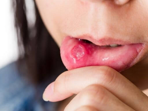 Стоматит на слизистой полости рта